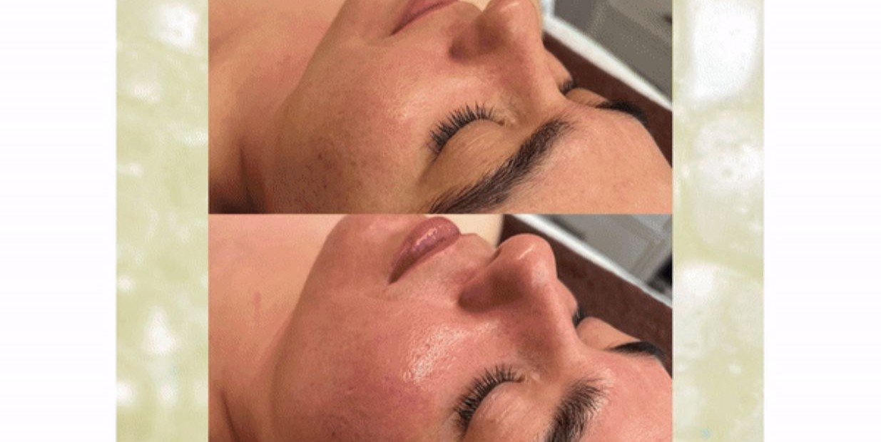 Glo2Facial